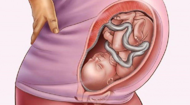 Che cos'è la placenta previa?