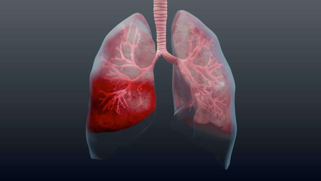 Cos’è la polmonite e quali sono i suoi sintomi? Come viene trattata la nuova epidemia da virus della polmonite?