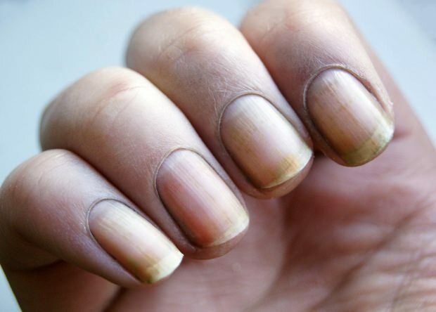 Perché l'unghia diventa gialla? Come sbiancare le unghie che diventano gialle dallo smalto?