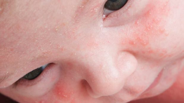 Come passa l'acne nei neonati?