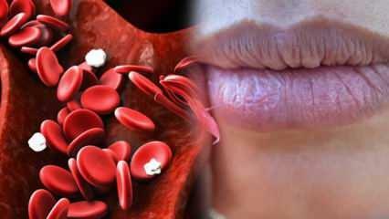 Cos'è l'anemia? La debolezza costante è un segno di anemia! Cibi che fanno bene all'anemia...