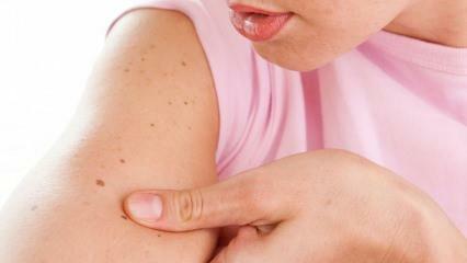 Cos'è il cancro della pelle (pelle) e quali sono i suoi sintomi? Modi per capire il cancro della pelle