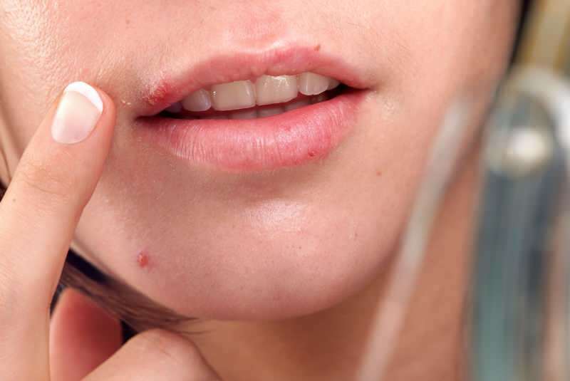 l'herpes di solito esce sul bordo del labbro.