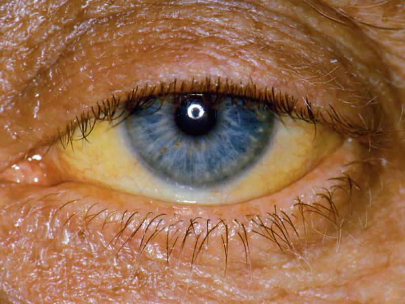l'altezza a livello di bilirubina provoca un colore giallo su occhi e pelle