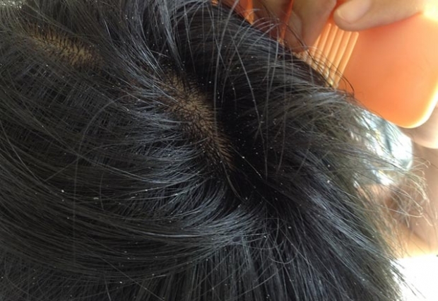 Perché l'acne sul cuoio capelluto