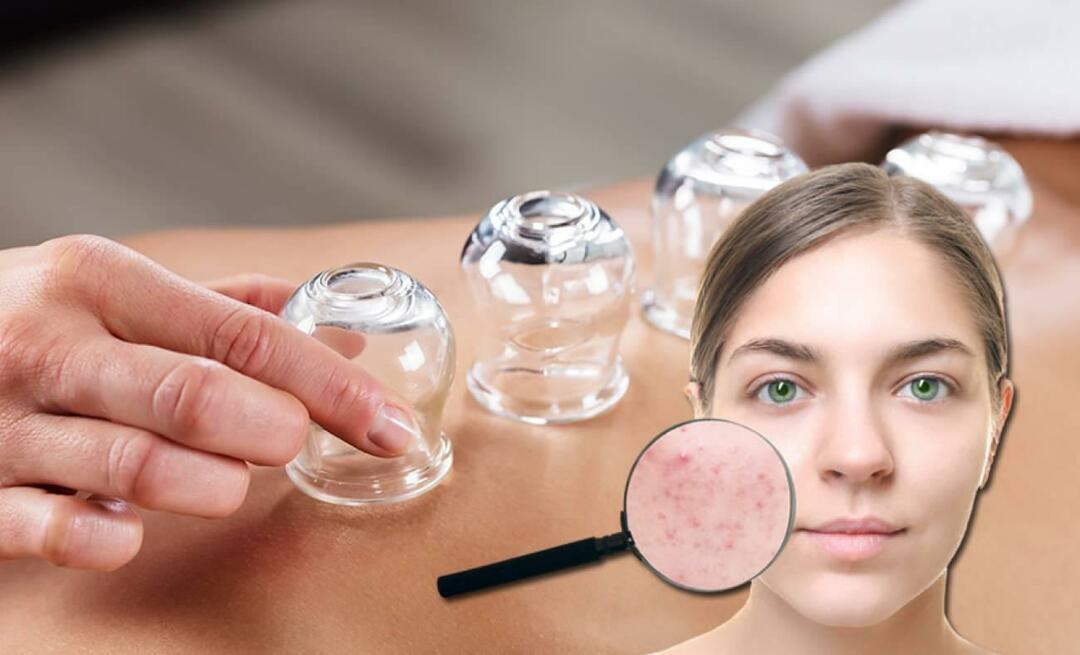 Quali sono i benefici della coppettazione per pelle e capelli? La coppettazione cura l'acne?