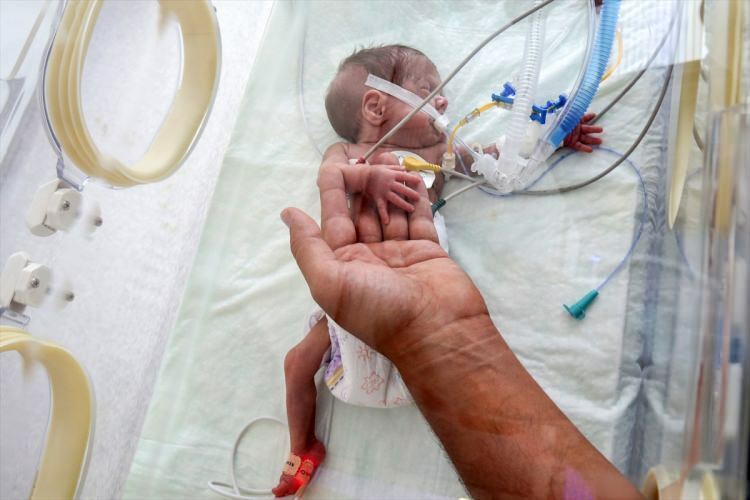 'Miracle baby' è riuscito a sopravvivere alla chirurgia