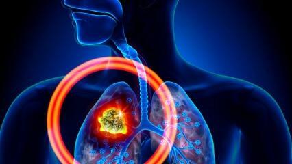 Quali sono i sintomi del cancro ai polmoni? Esiste una cura per il cancro ai polmoni?