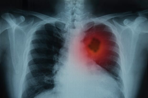 Quali sono i sintomi del cancro ai polmoni? Esiste un trattamento per il cancro ai polmoni? Per prevenire il cancro ai polmoni ...