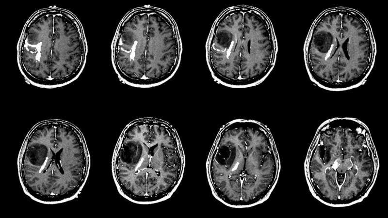 Cosa causa un tumore al cervello? Quali sono i sintomi di un tumore al cervello? Il trattamento del tumore al cervello è difficile?