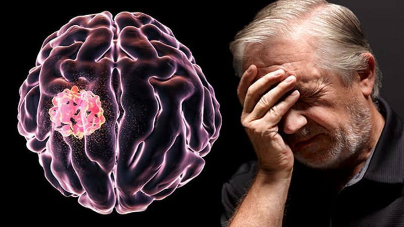 Il tessuto formato nel cervello dalla rottura delle strutture cellulari è chiamato tumore.