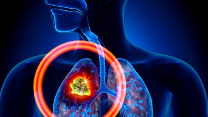 Quali sono i sintomi del cancro ai polmoni? Esiste un trattamento per il cancro ai polmoni? Per prevenire il cancro ai polmoni ...