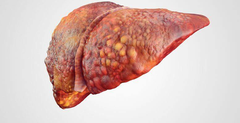 fasi del fegato grasso
