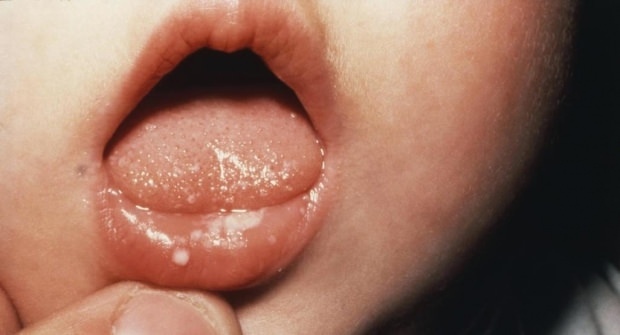 Come fa male alla bocca nei bambini