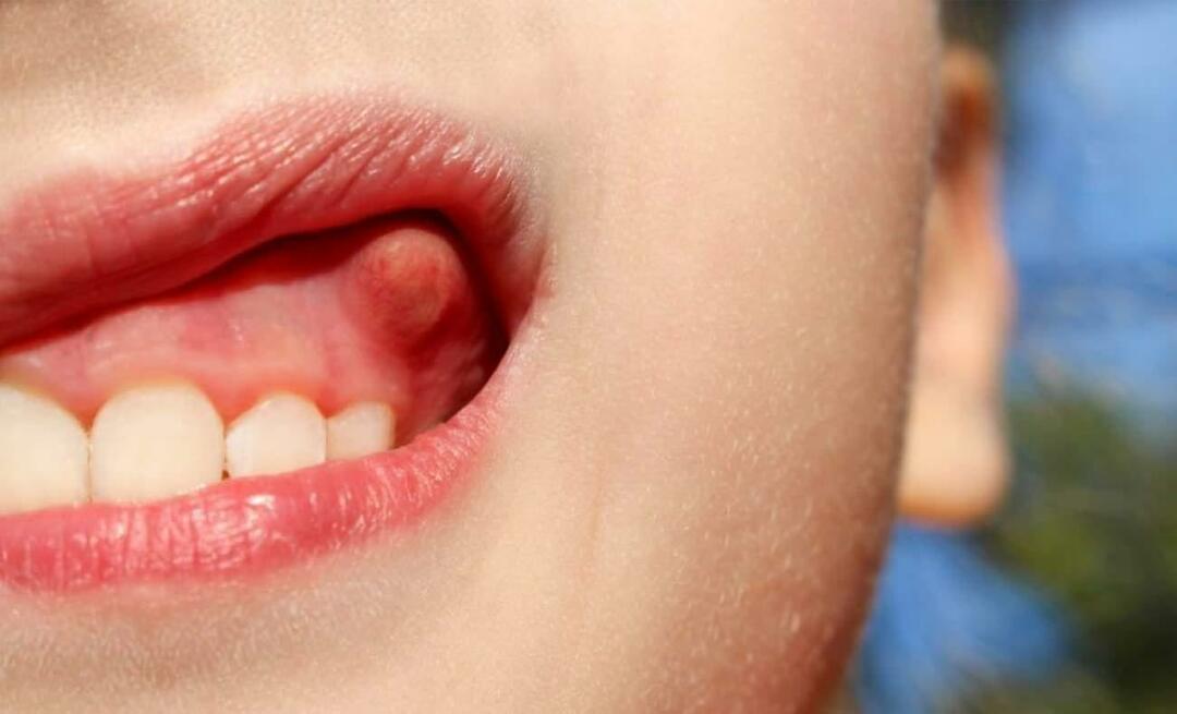 Perché l'ascesso dentale e quali sono i sintomi? Ascesso dentale, come si cura?