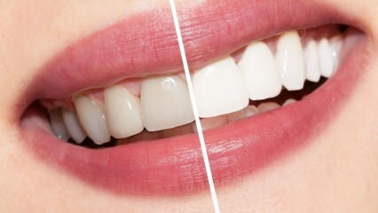 Quali sono i consigli per i denti bianchi? Cura sbiancante dei denti naturalmente a casa ...