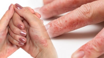 Che cos'è l'eczema? In che modo l'eczema è il più semplice? Colonia causa l'eczema della mano? 