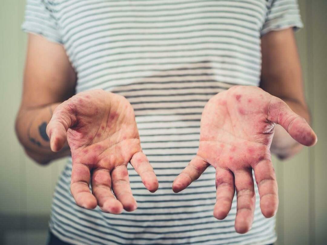 Quali sono i sintomi della malattia della mano, dell'afta epizootica