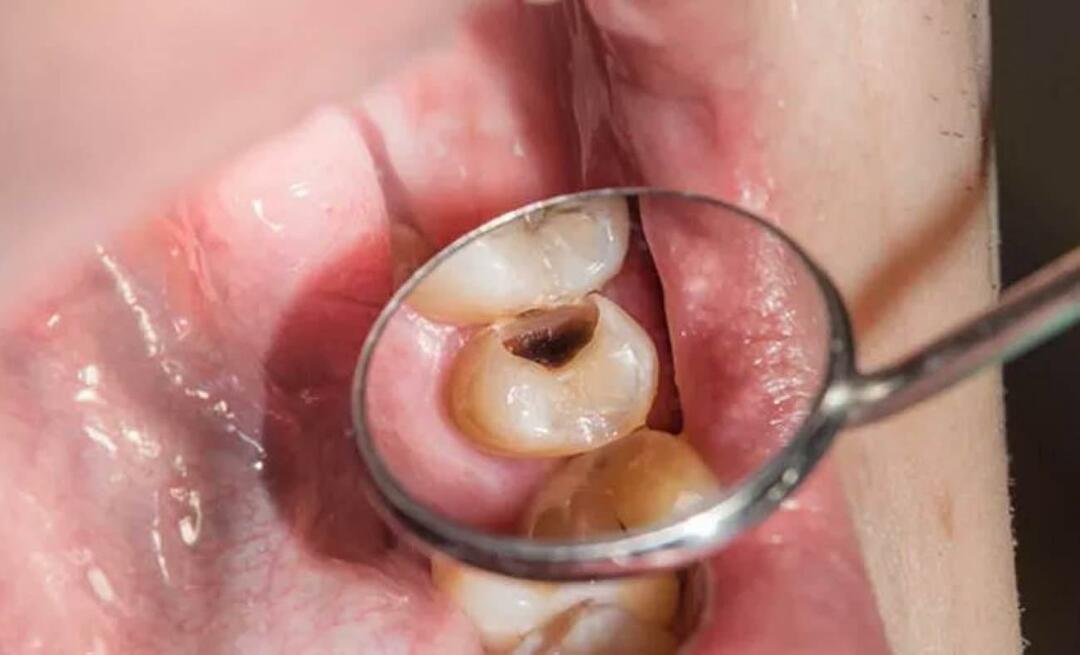 Perché i denti marciscono e cosa possiamo fare per prevenirlo? 