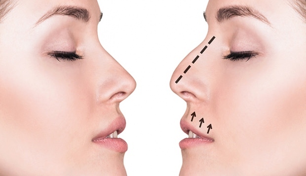 Cose da considerare nell'estetica del naso