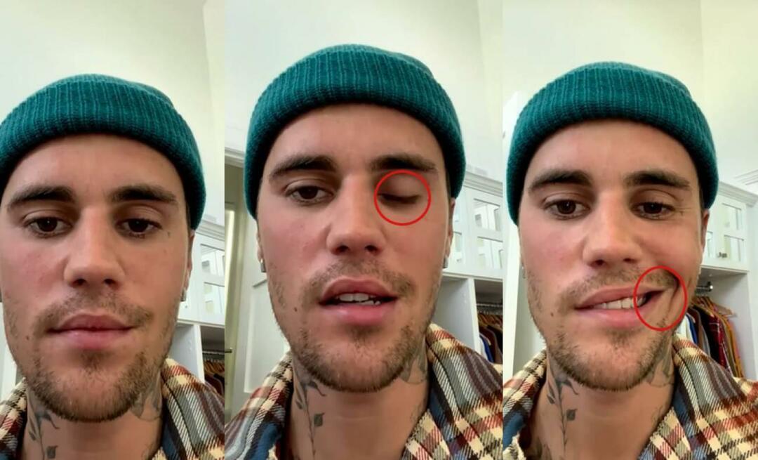 Justin Bieber ha avuto una paralisi facciale! La famosa star non può fare di nuovo un tour mondiale