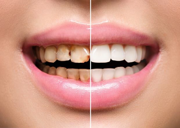 A causa di un'alimentazione non salutare, si verificano sia lo scolorimento che la perdita dei denti