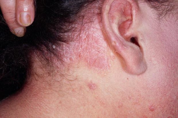 Quali sono i sintomi della dermatite seborroica e chi appare? Alimenti che scatenano la malattia
