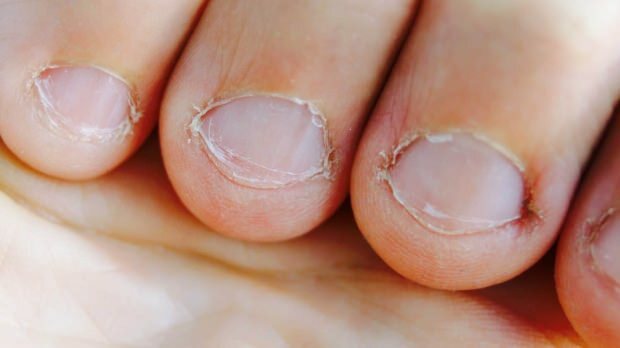 Che cos'è la malattia del consumo di unghie? Quali malattie provoca il consumo di unghie?