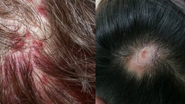 Perché l'acne appare sul cuoio capelluto