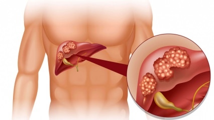 Quali sono i sintomi del cancro al fegato? Esiste un trattamento per il cancro al fegato?