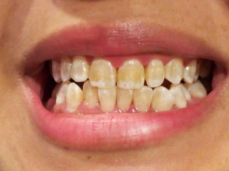immagine del dente di una persona i cui denti iniziano a scurirsi