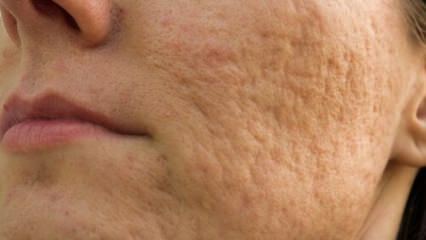 Come vanno le cicatrici da acne sul viso? Maschera ricette che rimuovono le cicatrici da acne