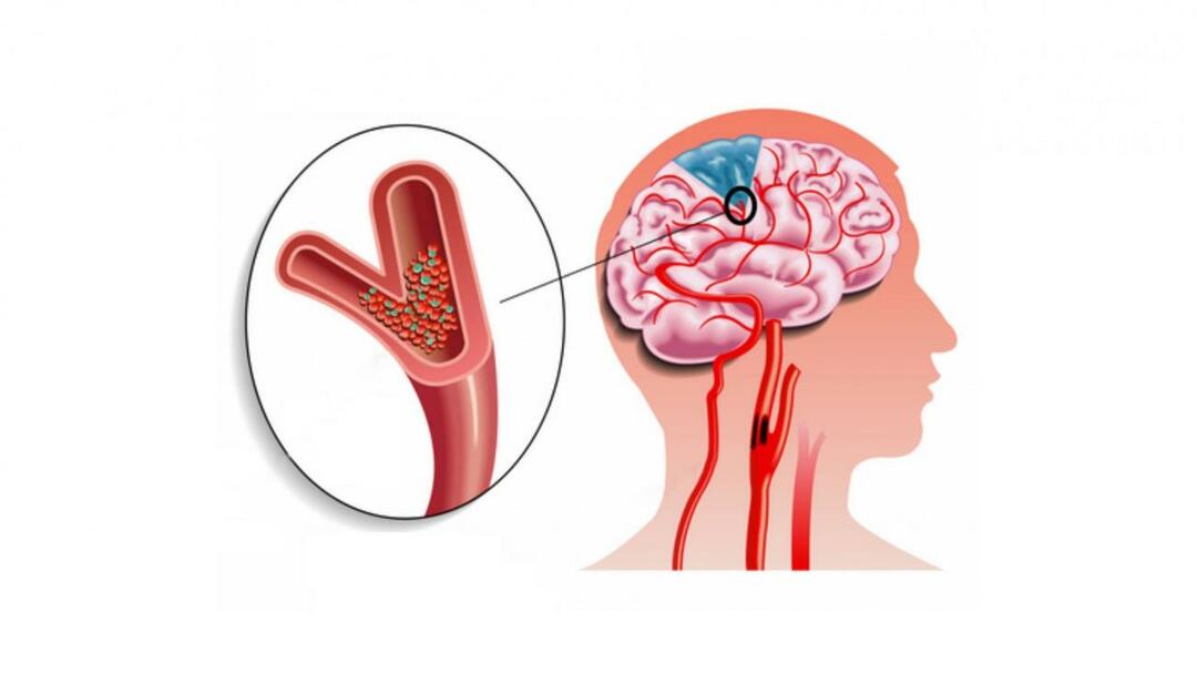 Disagio alle gambe e alle braccia: embolia! Cos'è un'embolia? Quali sono i sintomi dell'embolia?