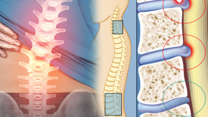 Che cos'è il restringimento del midollo spinale? Quali sono i sintomi del restringimento del midollo spinale? Esiste una cura per il restringimento del midollo spinale?