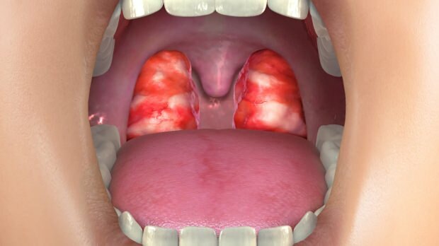 una vista delle tonsille gonfie a causa di infiammazione