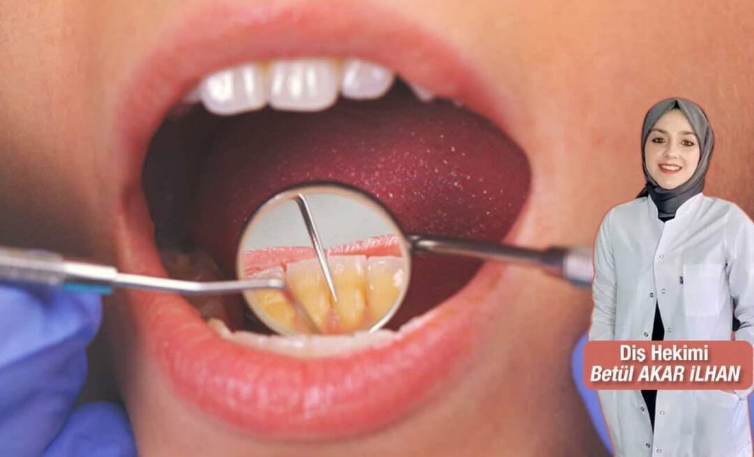 Cosa si dovrebbe fare per evitare il tartaro? Quali sono i vantaggi della detartrasi dentale?