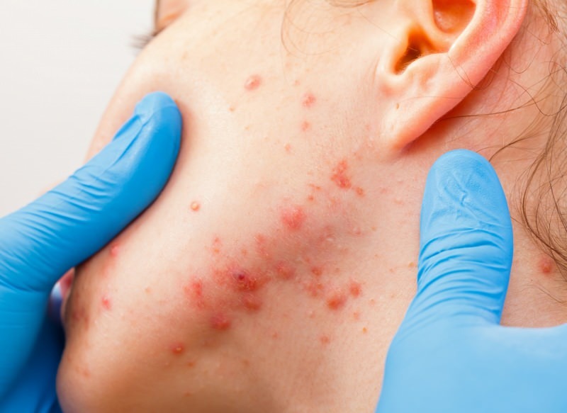 il virus provoca vesciche sulla superficie della pelle