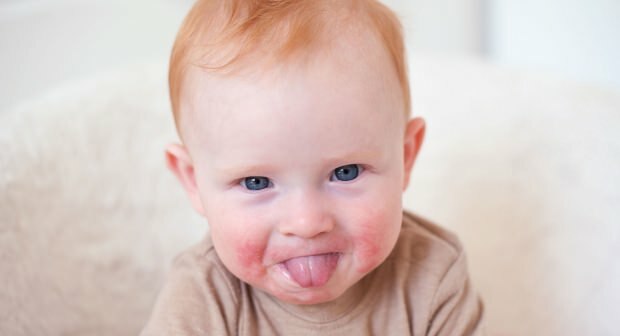 Attenzione nei bambini con le guance rosse! Sindrome della guancia schiacciata e suoi sintomi