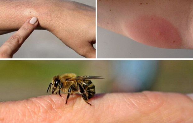 sintomi allergici alle api