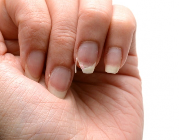 Come viene curata l'unghia? Metodi di estensione rapida delle unghie