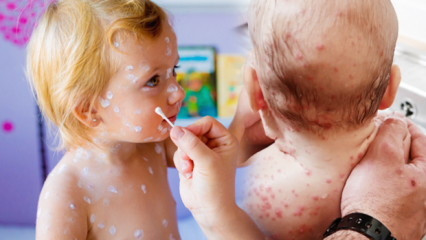 Come capire la varicella nell'infanzia e nell'infanzia? Sintomi e trattamento della varicella