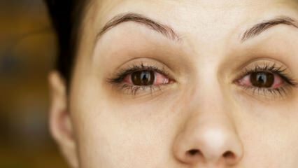 Che cos'è la congiuntivite (influenza oculare) e quali sono i suoi sintomi? Come viene trasmessa la congiuntivite?