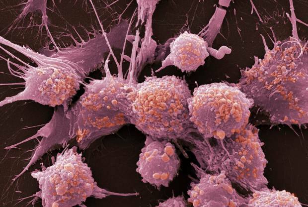 Cos'è il cancro e quali sono i suoi sintomi? Quanti tipi di cancro esistono? Come si previene il cancro?