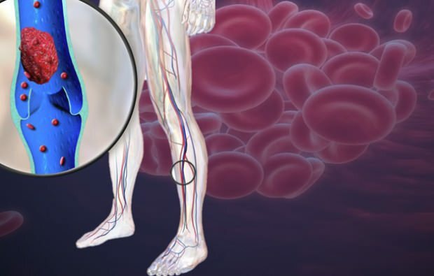 la riduzione della circolazione sanguigna nelle vene delle gambe provoca dolore